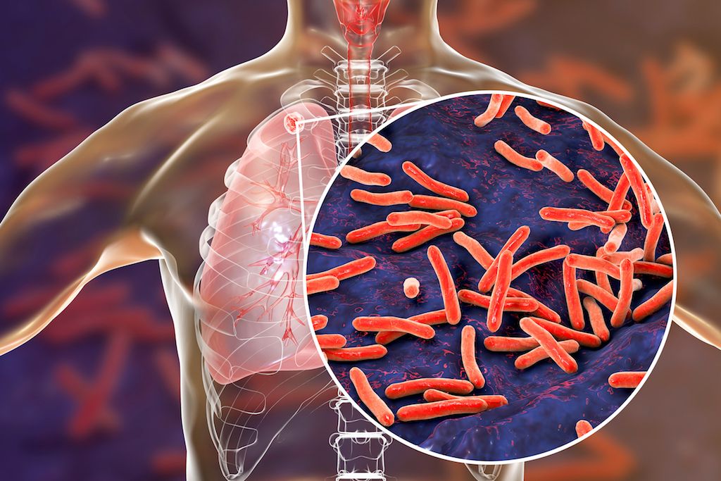 Tuberculosis Treatment