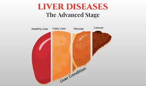 Hypertension Management