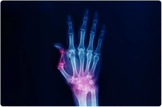 Rheumatology Treatment