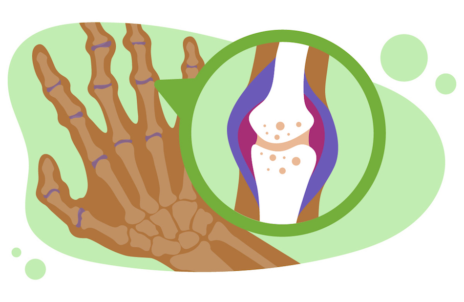 Rheumatology Treatment